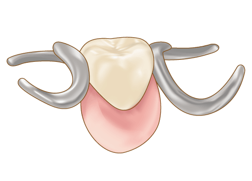 部分入れ歯
